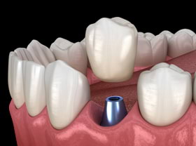 Имплантация зубов в Краснодаре